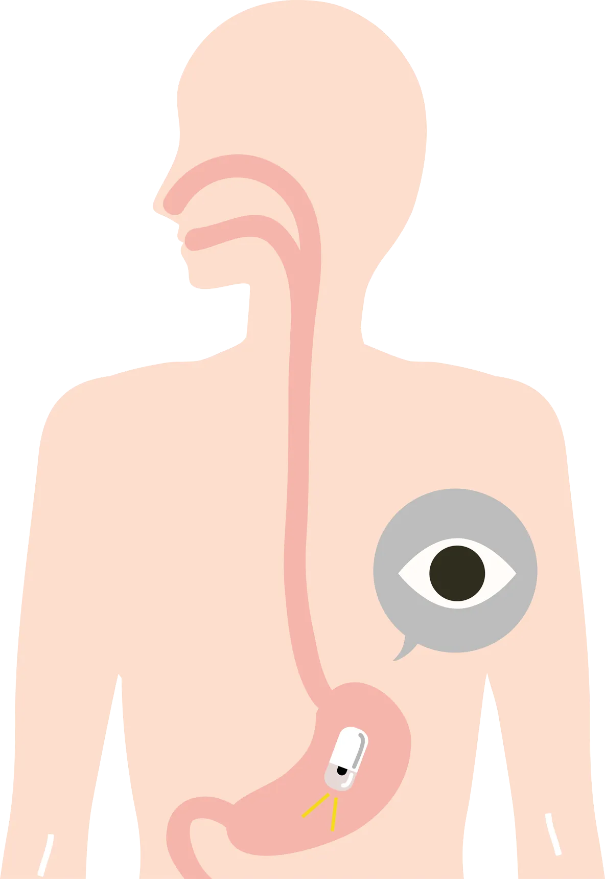 Capsule endoscopy diagram